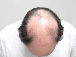 Adiós Calvicie Hola Melena Perfecta